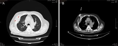 Malignant granular cell tumor in the thoracic wall: A case report